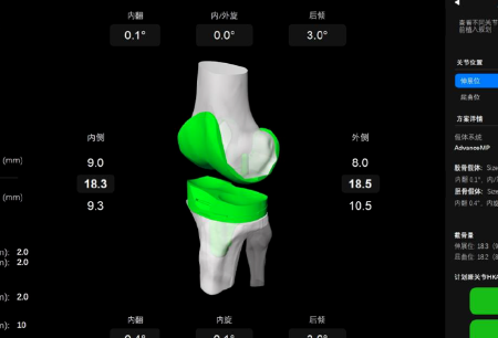 MicroPort® NaviBot® Knee Replacement Surgery Planning Software Approved by NMPA